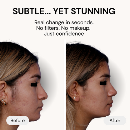 Oaks Instant Nose Lift Kit